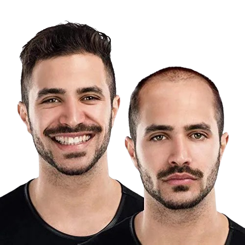 Hair Patch Fixing (Non-Surgical)