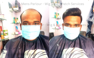Wig & Hair Patch Services in Chinhat
